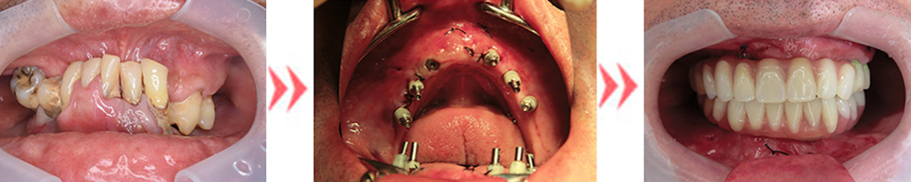痛みを限りなく少なくした全体的インプラント治療 千葉県でインプラントなら千葉インプラントセンター船橋